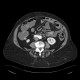 Diverticulosis, colonic diverticulum: CT - Computed tomography